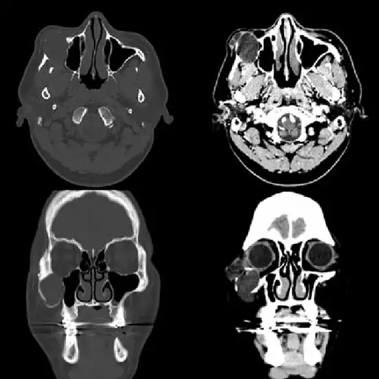 CT (computed tomography) Facial Bone Test